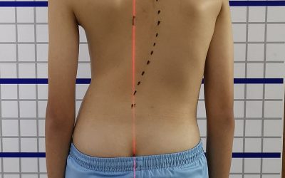 Do you have scoliosis symptoms? This is what you should do
