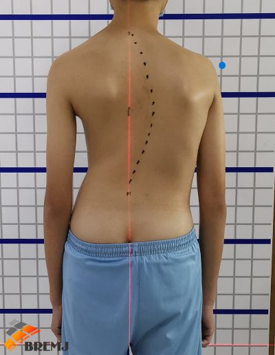 scoliosis assessment