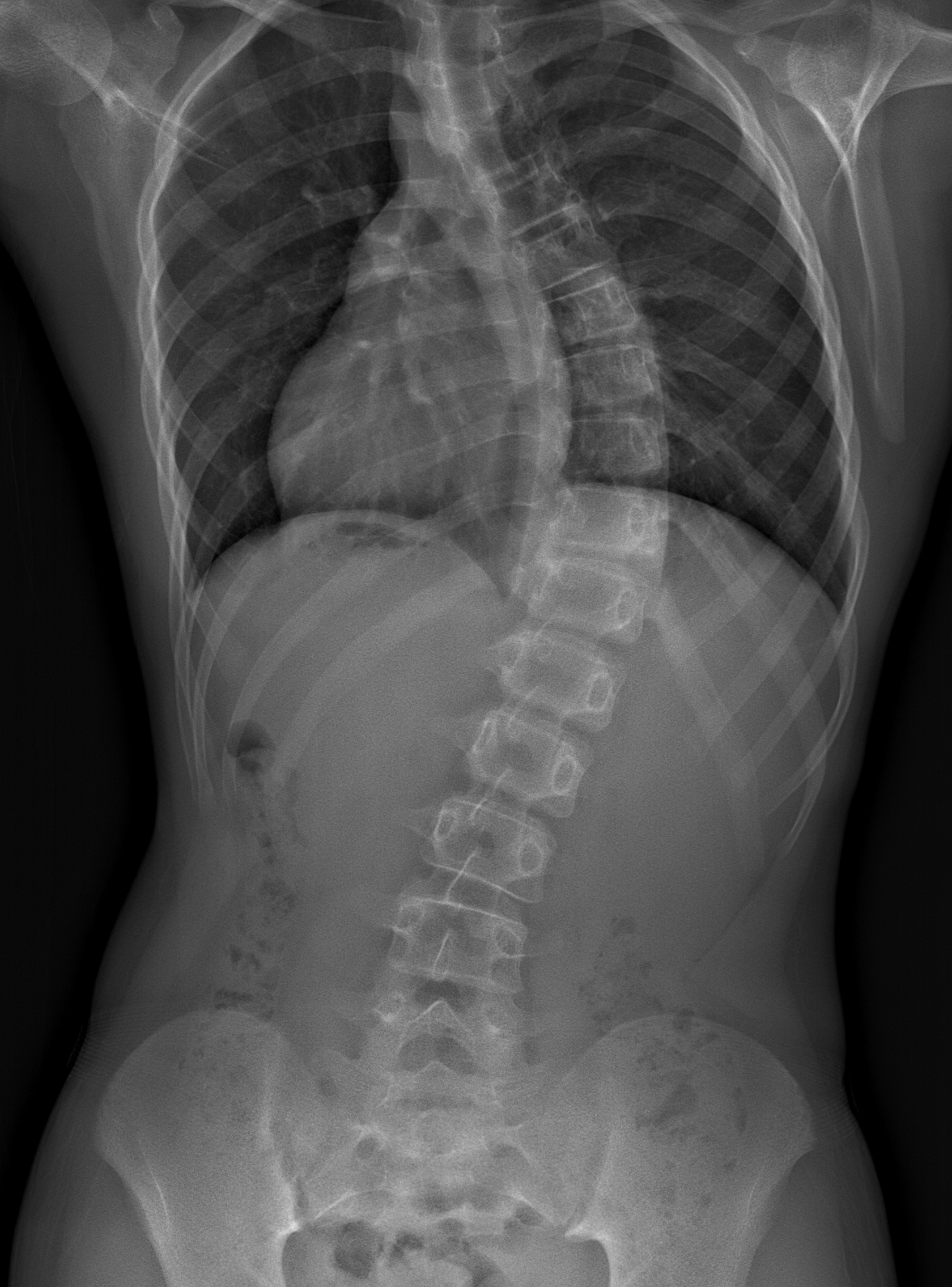 scoliosis xray scan